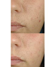 Load image into Gallery viewer, Blemish + Age Defense